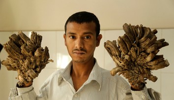 Stromový muž má nádej. Už mu odstránili 5 kíl bradavíc