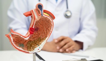 Rakovina žalúdka sa spočiatku prejavuje nenápadne. Najčastejšie príznaky, ktoré ľudia ignorujú