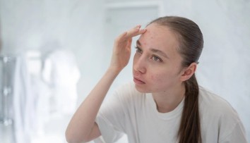 Akné nie je len pubertálny problém. Dermatologička radí, na čo si dať pozor