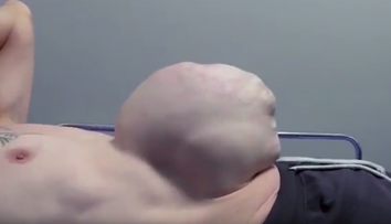 Musel žiť s obrovským pruhom. Bol veľký ako futbalová lopta