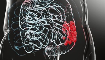 Rakovina hrubého čreva a konečníka je najčastejšie nádorové ochorenie u nás. Tieto príznaky by ste nemali ignorovať