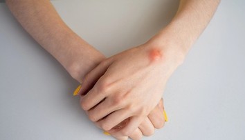 Nahmatali ste si hrčku pod kožou? Jeden detail prezradí viac než si myslíte