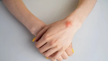 Nahmatali ste si hrčku pod kožou? Jeden detail prezradí viac než si myslíte