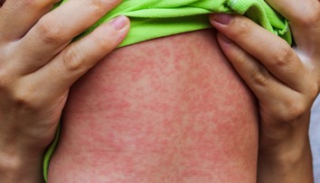 Epidémia osýpok neďaleko Austrálie. Zomrelo už 50 detí