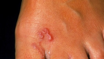 Pozor na nechcený suvenír z dovolenky. Strašidelného tropického parazita môžete chytiť na pláži