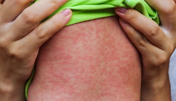 O slovo sa hlásia osýpky či čierny kašeľ. Podľa odborníkov pred dovolenkou treba myslieť na jednu vec