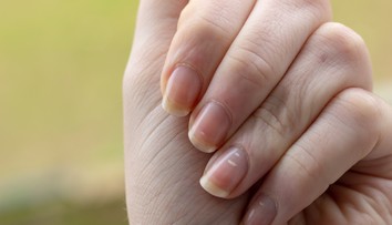 Biele škvrny či ryhy na nechtoch. Môžu poukazovať na nedostatok vitamínov, ale aj vážne ochorenia
