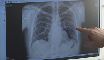 Blížime sa k dôležitej zmene. Rakovinu pľúc zväčša pacientom odhalia až v pokročilom štádiu