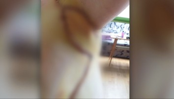 Z drobnej vyrážky sa stal boj o normálny život. Žena nedokázala dvihnúť ruky, lekári ju zachránili v hodine dvanástej