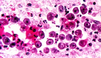 „Mozgožravá“ améba znovu zabíjala: Žena mala mimoriadne nepríjemné príznaky