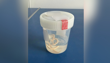 Tlak na hrudi či dýchavičnosť nemusia znamenať len problémy so srdcom. Klinika upozorňuje na kuriózny prípad