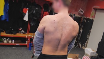 Majú perfektne vyformované telá, no plné vyrážok. Dermatologička vysvetľuje, prečo akné trápi profesionálnych športovcov