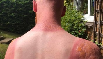 Záhradník si chcel zarobiť na dovolenku, skončil s popáleninami druhého stupňa