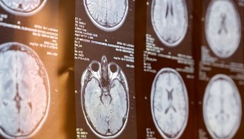 Pri mozgovej príhode rozhodujú minúty. Neurochirurg opísal príznaky, ktoré netreba ignorovať