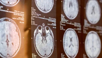 Pri mozgovej príhode rozhodujú minúty. Neurochirurg opísal príznaky, ktoré netreba ignorovať