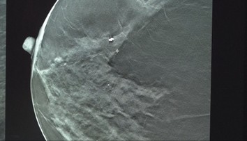 Inovácia, ktorá mení životy. Slovensko má novú metódu v boji s rakovinou