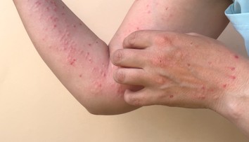 Na Slovensku potvrdili päť prípadov opičích kiahní