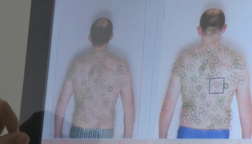 Pozor na UV žiarenie spôsobujúce rakovinu. Na Slovensku najviac ohrozuje tieto skupiny ľudí