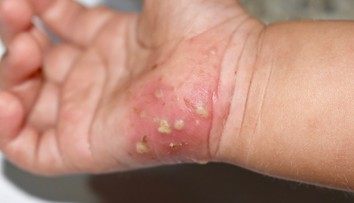 Svrab sa šíri rýchlo a nenápadne. Spoznajte príznaky, kým nie je neskoro