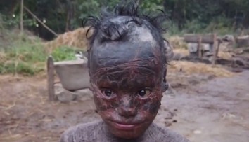 VIDEO: Chlapec (10) trpí vzácnou mutáciou. Jeho koža rýchlo schne a zhadzuje sa