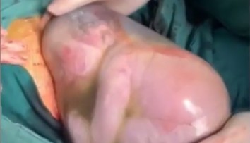 Chlapček sa narodil s "čepcom šťasteny". Dýchať začal až po dvoch minútach