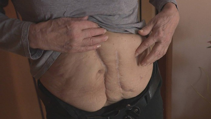 Jazvy na bruchu, ktoré má pani Ľubica Šebová.