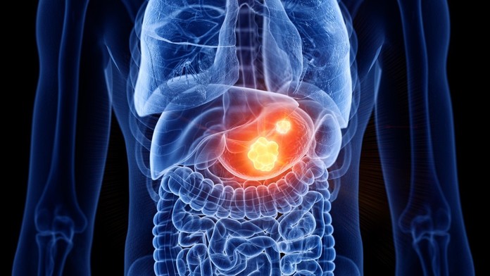 Rakovina žalúdka (ilustračná snímka)