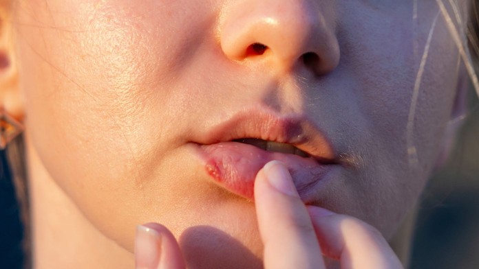 Herpes. Ilustračná snímka.