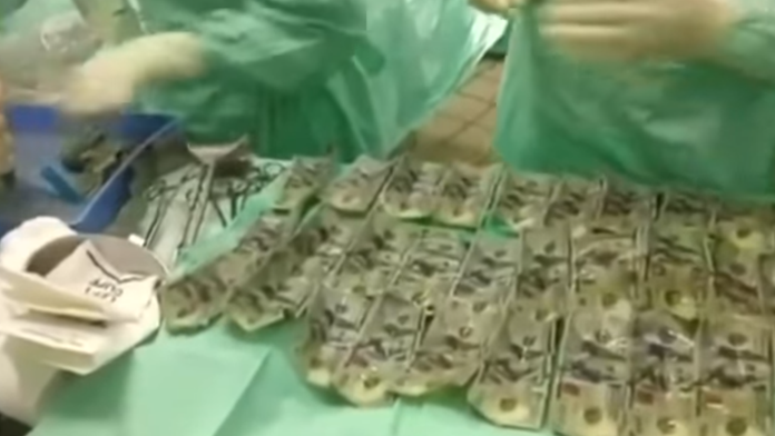 Bankovky vytiahnuté zo žalúdka.