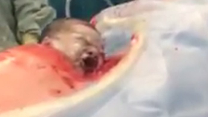 Prirodzený cisársky rez