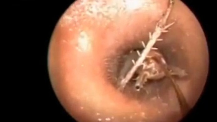 Mužovi vytiahli lekári z ucha živého cvrčka