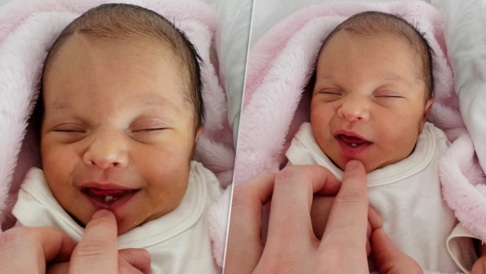 Lekári zostali v šoku. Na strednom Slovensku sa narodilo bábätko so zubom