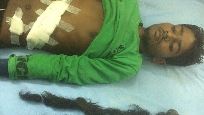 Parazitické dvojča malo vlasy, zuby a kosti