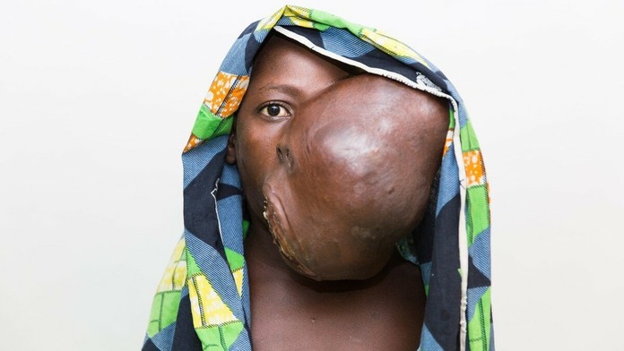 Kaltoumi z Afriky mala na tvári obrosvký nádor