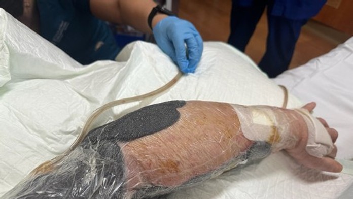 Mäsožravá infekcia mu takmer vzala život. V jednu chvíľu mi bolo vidieť skrz ruku, popísal