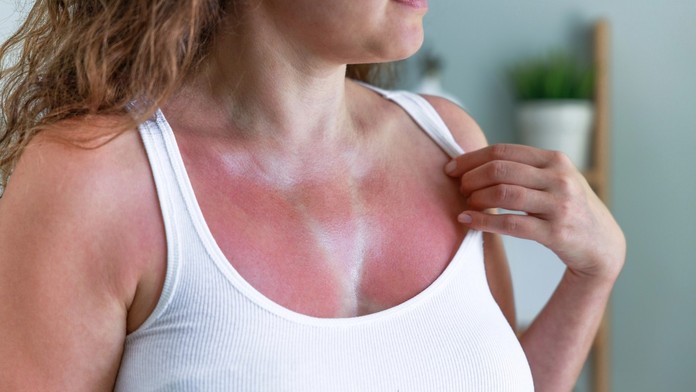 Spálená pokožka (ilustračná snímka)