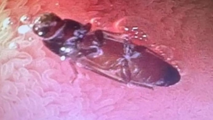 Mladík sa sťažoval na zažívacie problémy. Lekári zostali v šoku, keď zistili, čo má v žalúdku