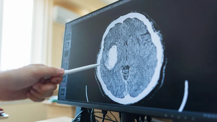 Revolúcia v liečbe rakoviny: Nový test skrátil diagnostiku nádorov mozgu z týždňov na hodiny