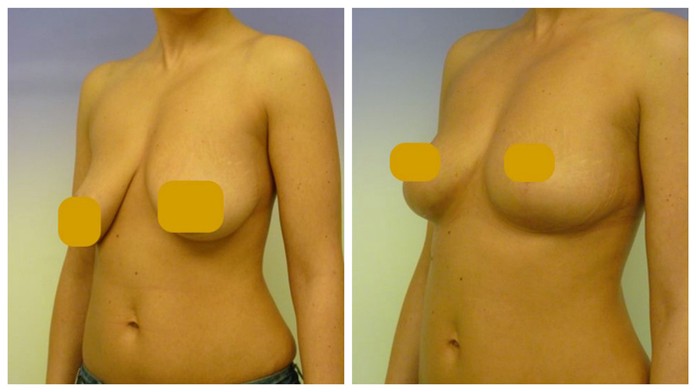 Zmenšené prsia, ktoré si dala klientka po dojčení.