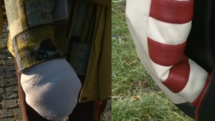 Košičanovi odrezali ruku