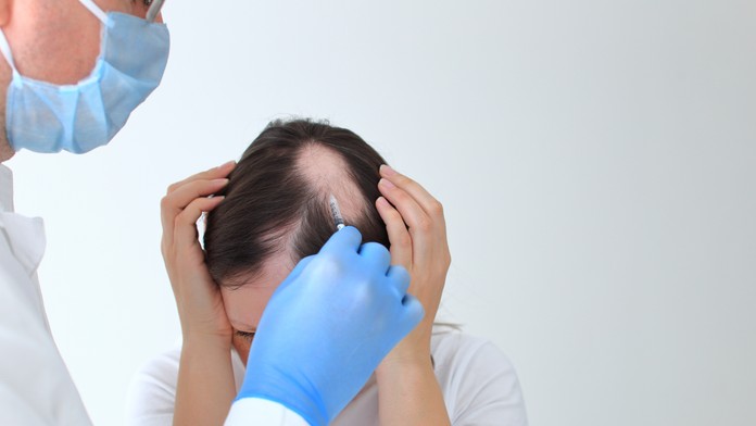 Schválili prvý účinný liek proti plešinám. Funguje takmer u polovice pacientov