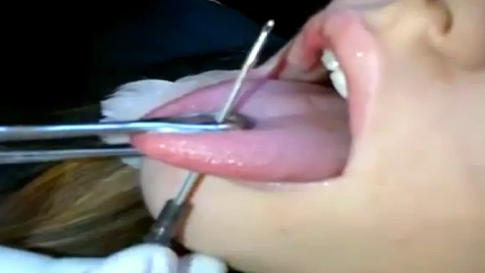 Riziká piercingu