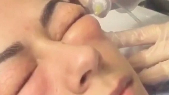 351288B100000578-3632273-Ow_In_a_video_posted_to_YouTube_a_woman_has_the_gas_injected_und-a-3_1465437499695.jpg