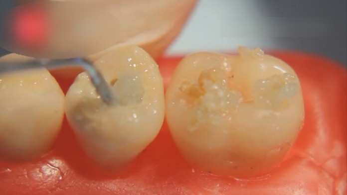 Namiesto vŕtania liečivý gel.