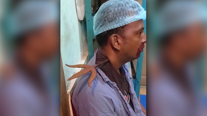 Indovi pri bitke prepichli krk trojzubcom, lekári hovoria o medicínskom zázraku