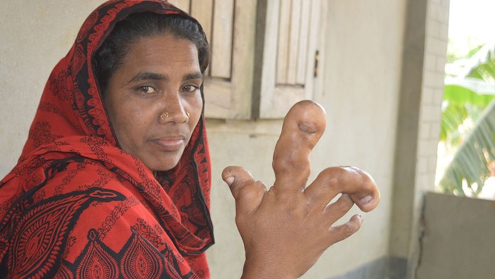 Afroza Begum z Bangladéša trpí neznámou poruchou.