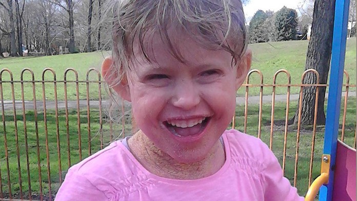 Rebecca Bradleyová bojuje so zvláštnym kožným ochorením.