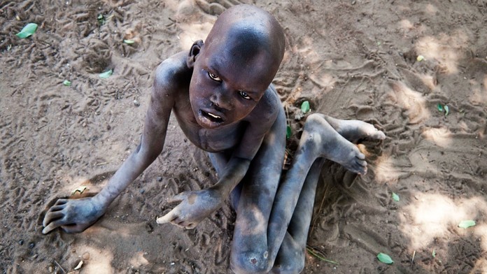 Rodičom pomaly odchádzajú pred očami. V srdci Afriky sa šíri záhadná choroba, ktorá deťom požiera mozgy