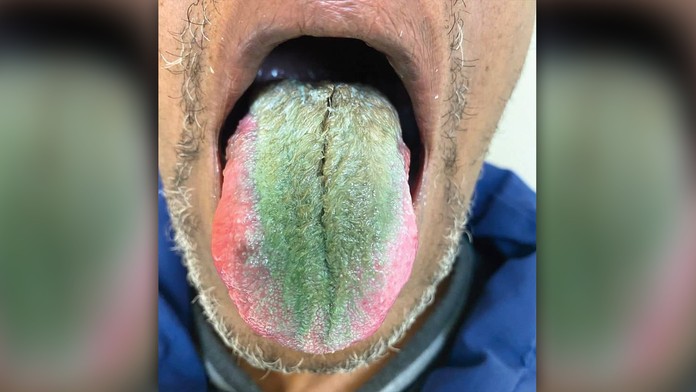 Lekári opísali bizarný prípad: Mužovi sa na jazyku vytvoril zelený povlak pripomínajúci srsť