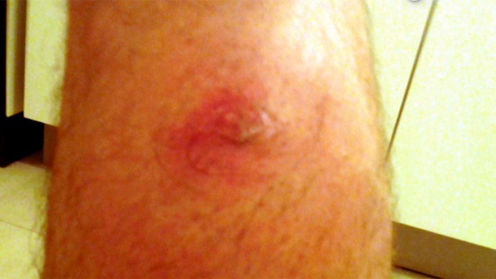 Slovákov trápi hmyz. Pozor na nebezpečné agresívne štípance